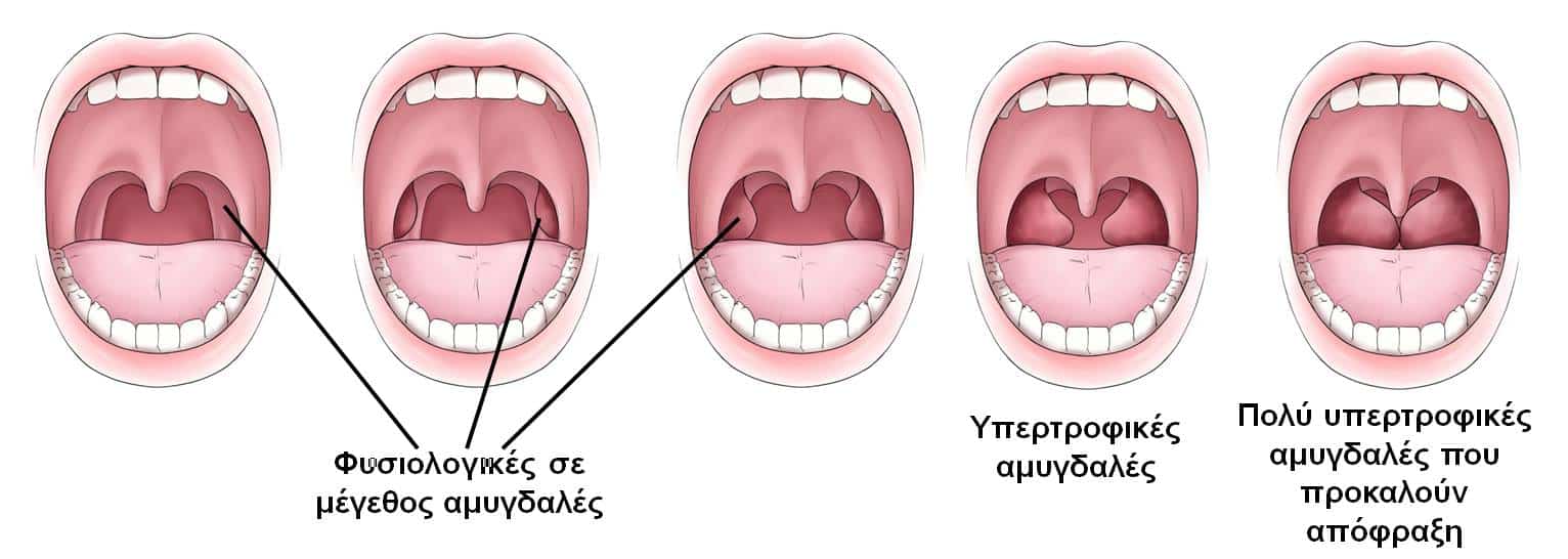 Η αφαίρεση αμυγδαλών βελτιώνει τον ύπνο των παιδιών