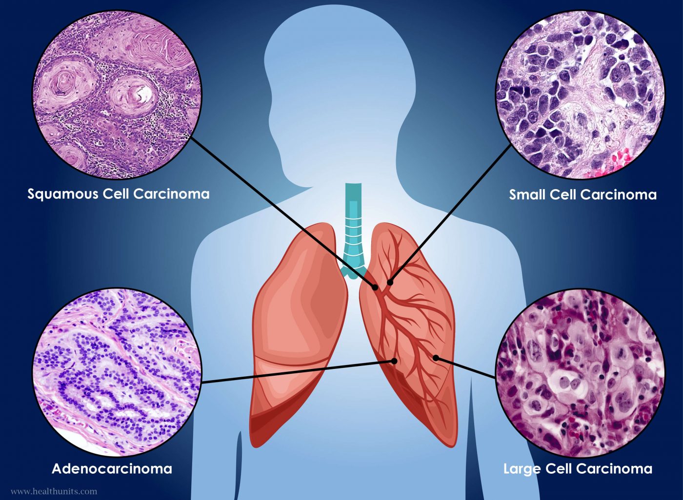 Εξέταση αίματος ανιχνεύει τον πρώιμο καρκίνο του πνεύμονα