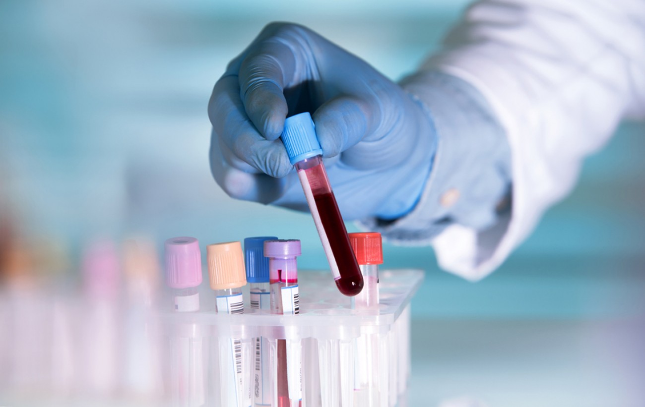 Εξελιγμένο τεστ αίματος προβλέπει τον καρκίνο του παγκρέατος