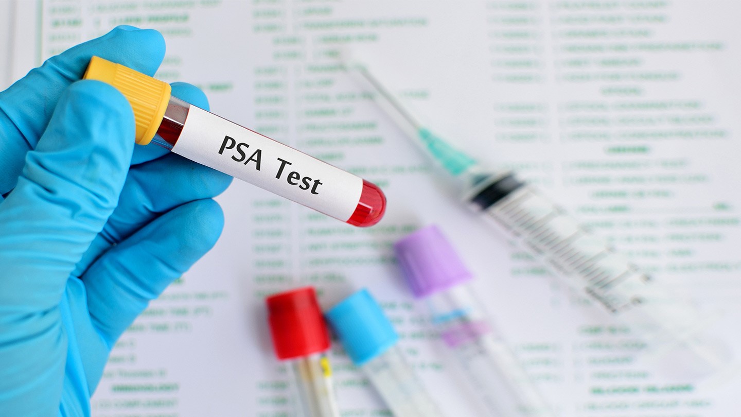 Αποτελεσματικό το τεστ PSA  για τη θεραπεία του καρκίνου προστάτη