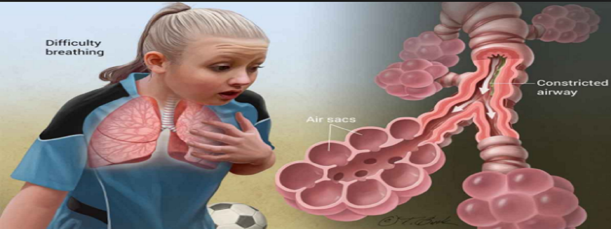 Μπορείτε να προστατευτείτε από τις κρίσεις άσθματος;