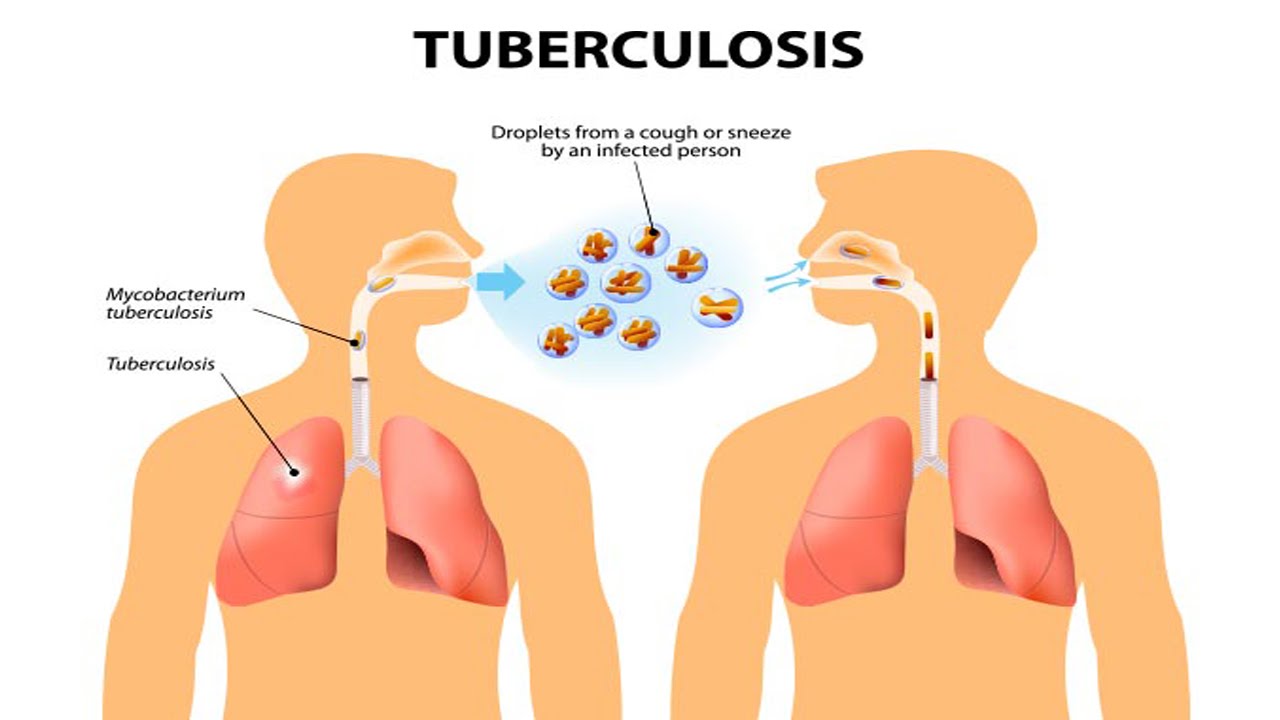 Ταυτοποίηση της ανθεκτικής φυματίωσης, πώς;