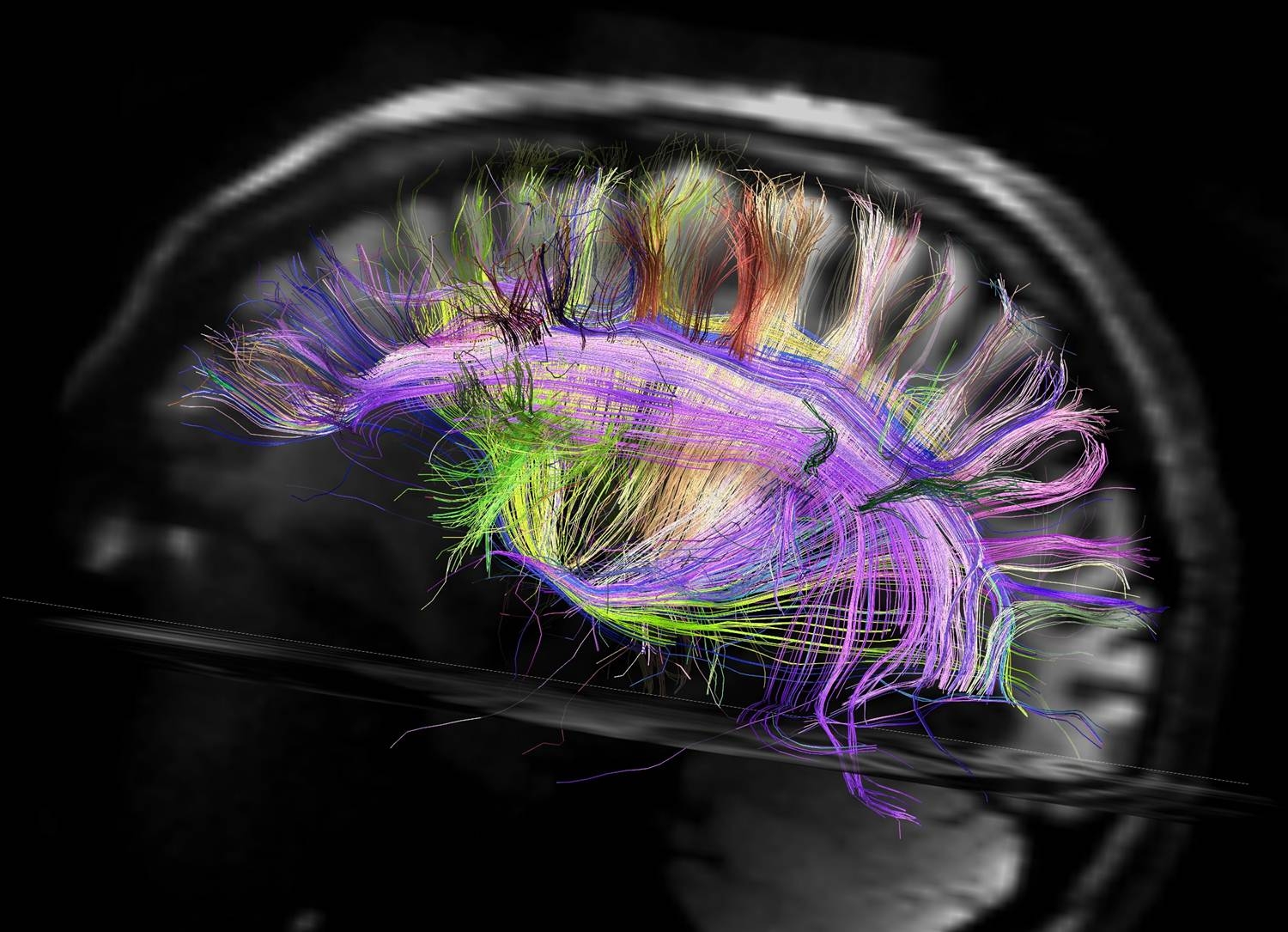 Ενδελεχής απεικόνιση στην καλωδίωση του εγκεφάλου των σχιζοφρενών