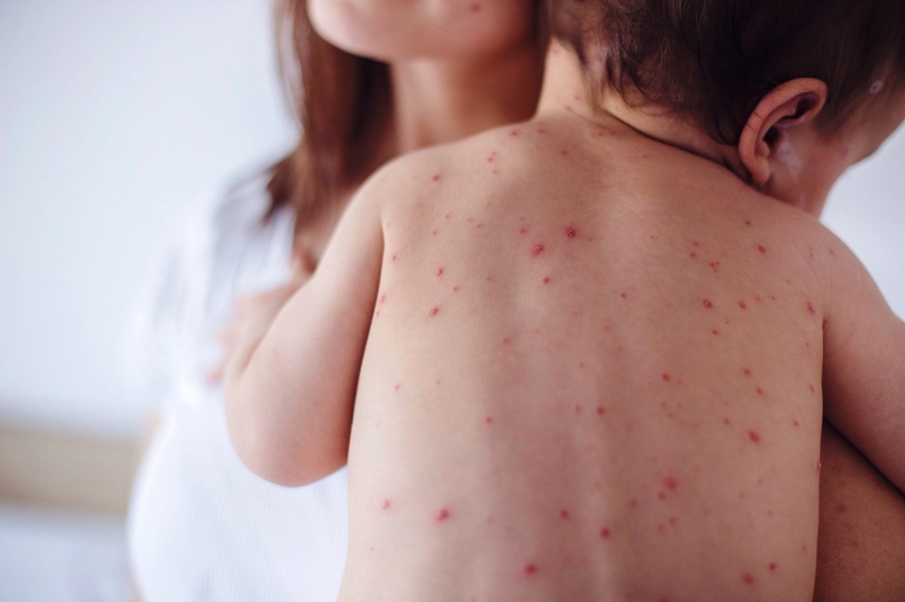 ΔΡΑΜΑΤΙΚΟ! Ένα βρέφος 11 μηνών το πρώτο θύμα της ιλαράς