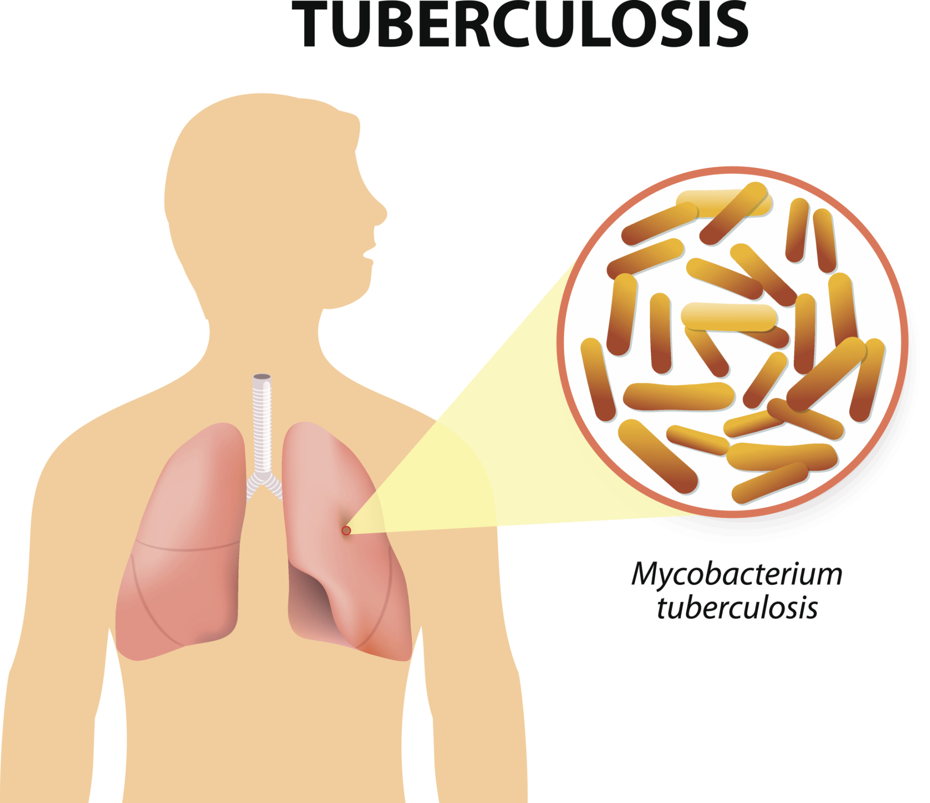 Νέα ευρήματα για την αντιμετώπιση της φυματίωσης
