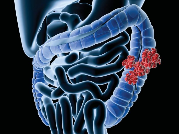 Η μετατόπιση της βακτηριακής κοινότητας στο στομάχι συνδέεται με καρκίνο;