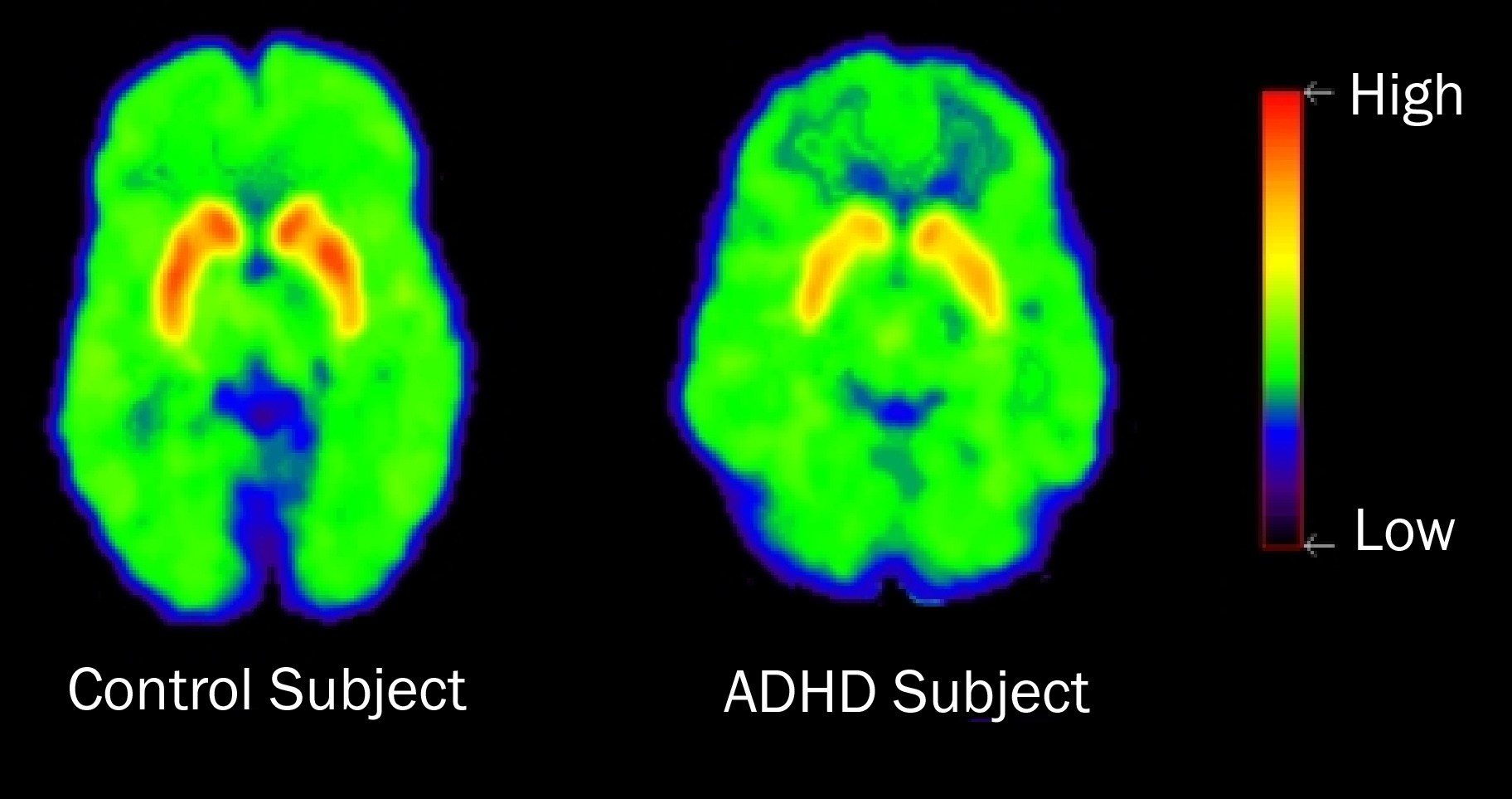 Απεικόνιση του εγκεφάλου στη Διαταραχή Ελλειμματικής Προσοχής – Υπερκινητικότητας