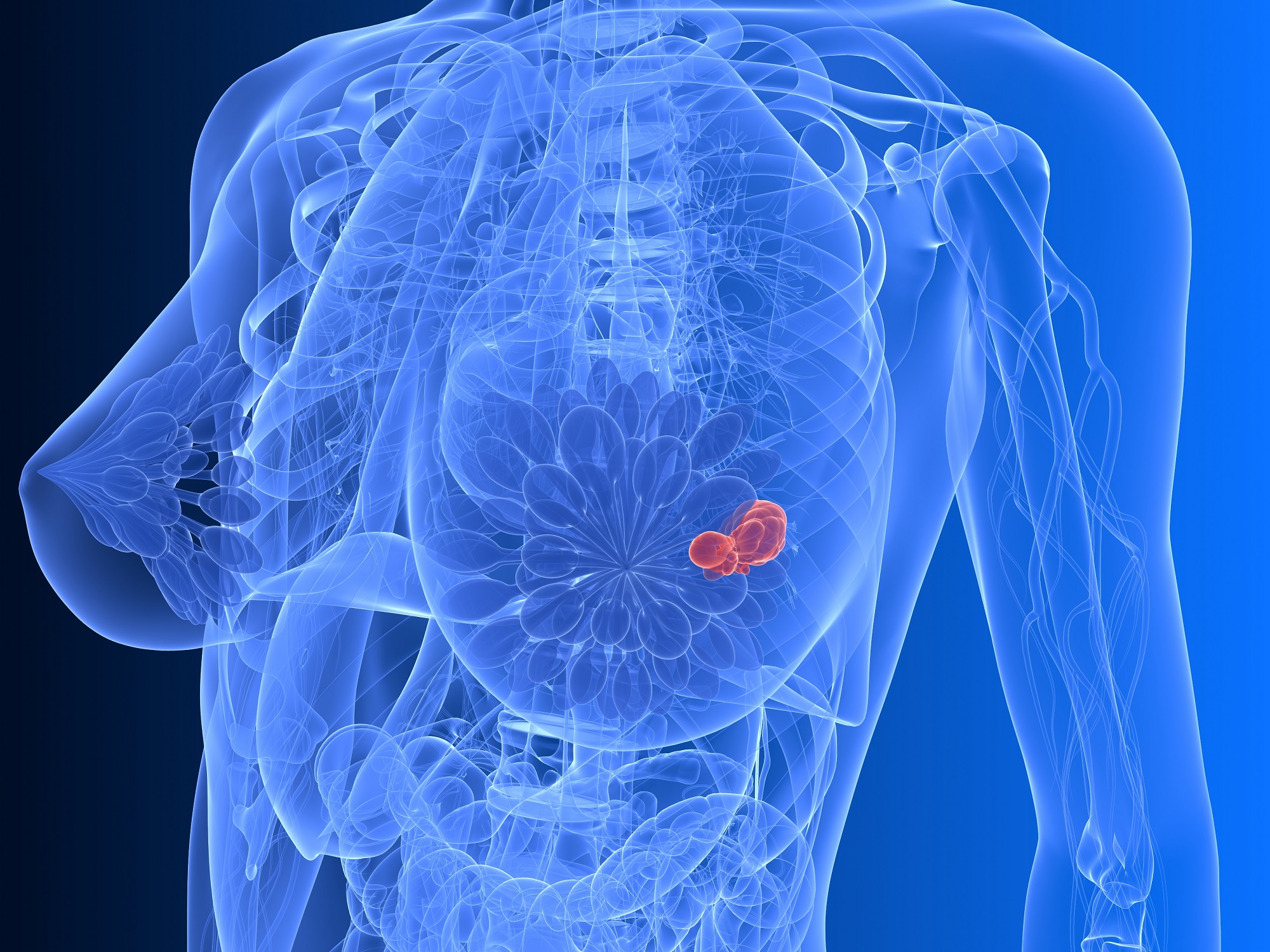 Υποτροπή του καρκίνου του μαστού πολλά έτη μετά τη θεραπεία