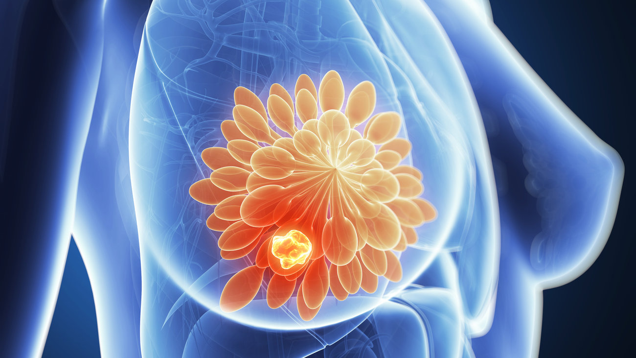 Νέος στόχος για τον «τριπλό αρνητικό» καρκίνο του μαστού