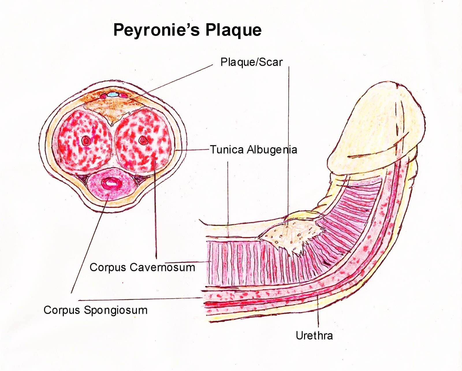 Με ποια είδη καρκίνου συσχετίζεται η νόσος Peyronie