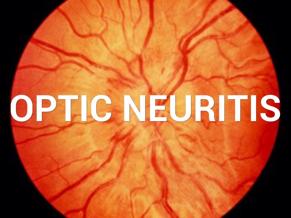 Παγίδες στη διάγνωση της οπτικής νευρίτιδας