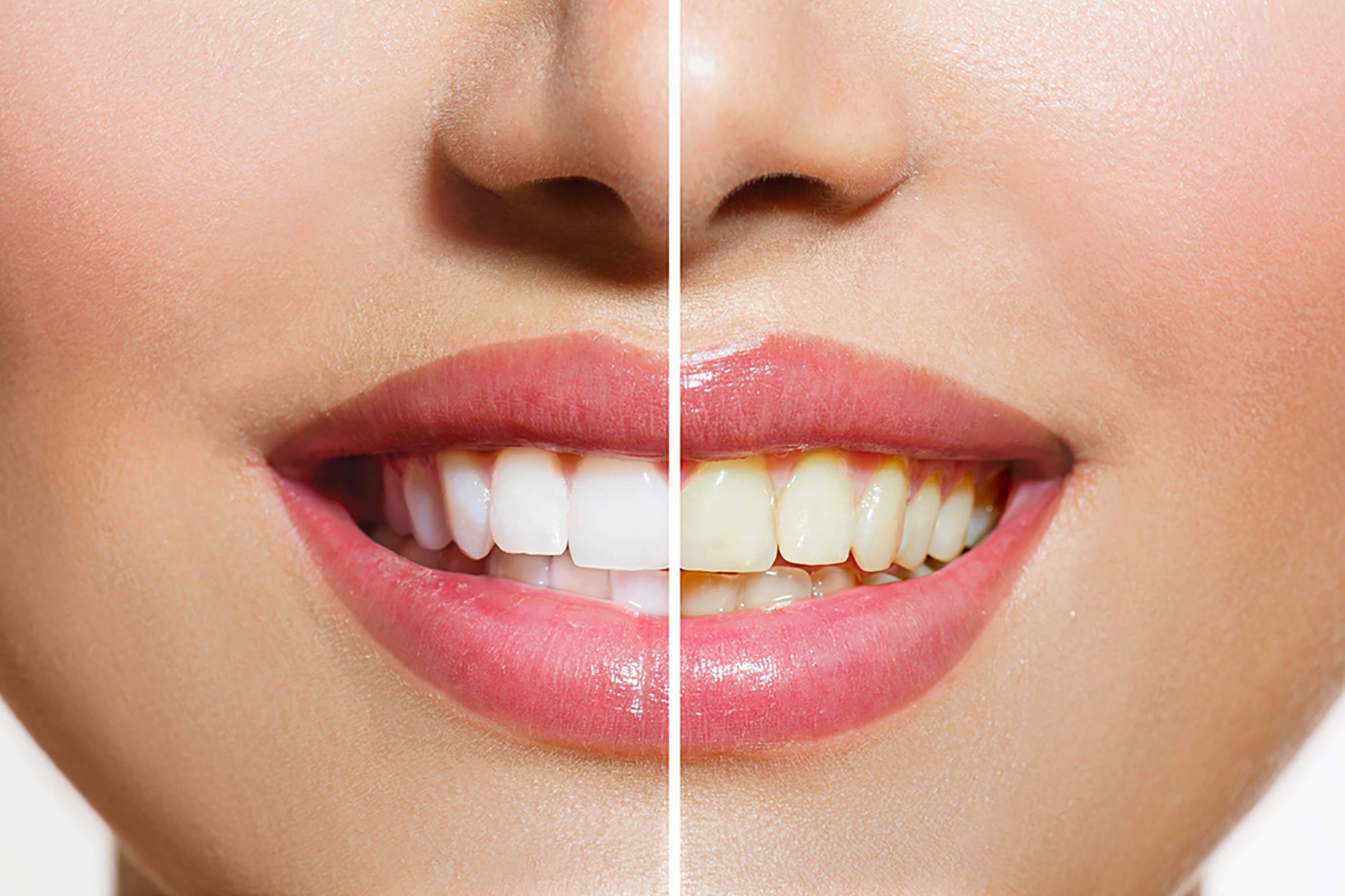 Τρεις συνήθειες που κιτρινίζουν τα δόντια σας