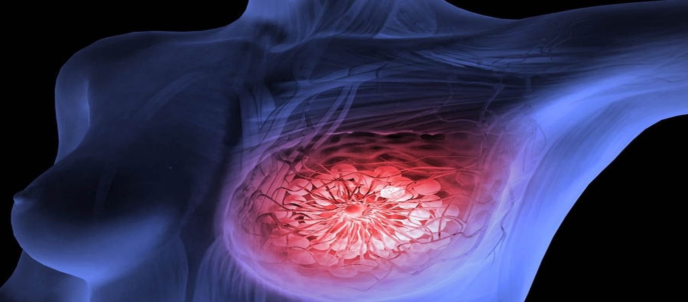 Ανακαλύφθηκαν 110 γονίδια που συνδέονται με τον καρκίνο του μαστού