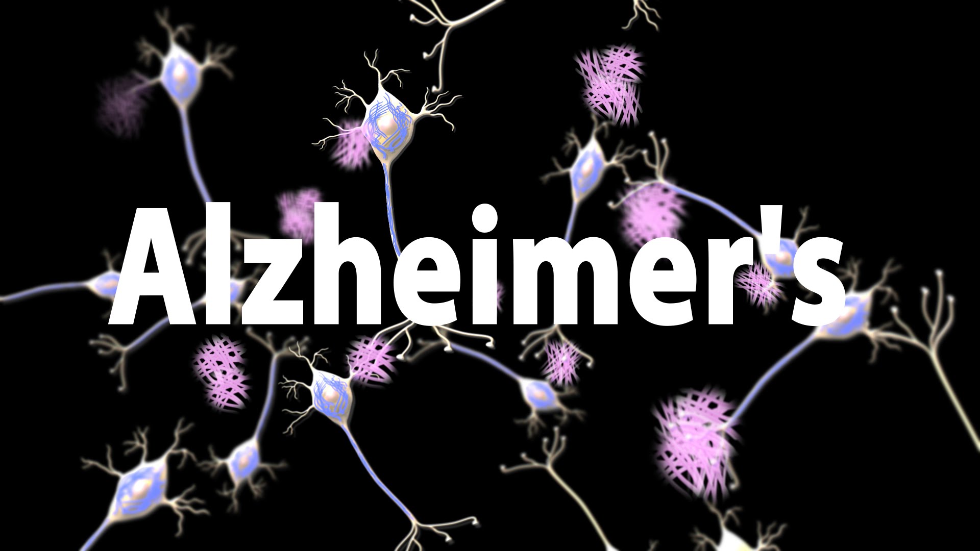 Καθορίστηκε ο γενετικός παράγοντας κινδύνου για τη νόσο Αλτσχάιμερ