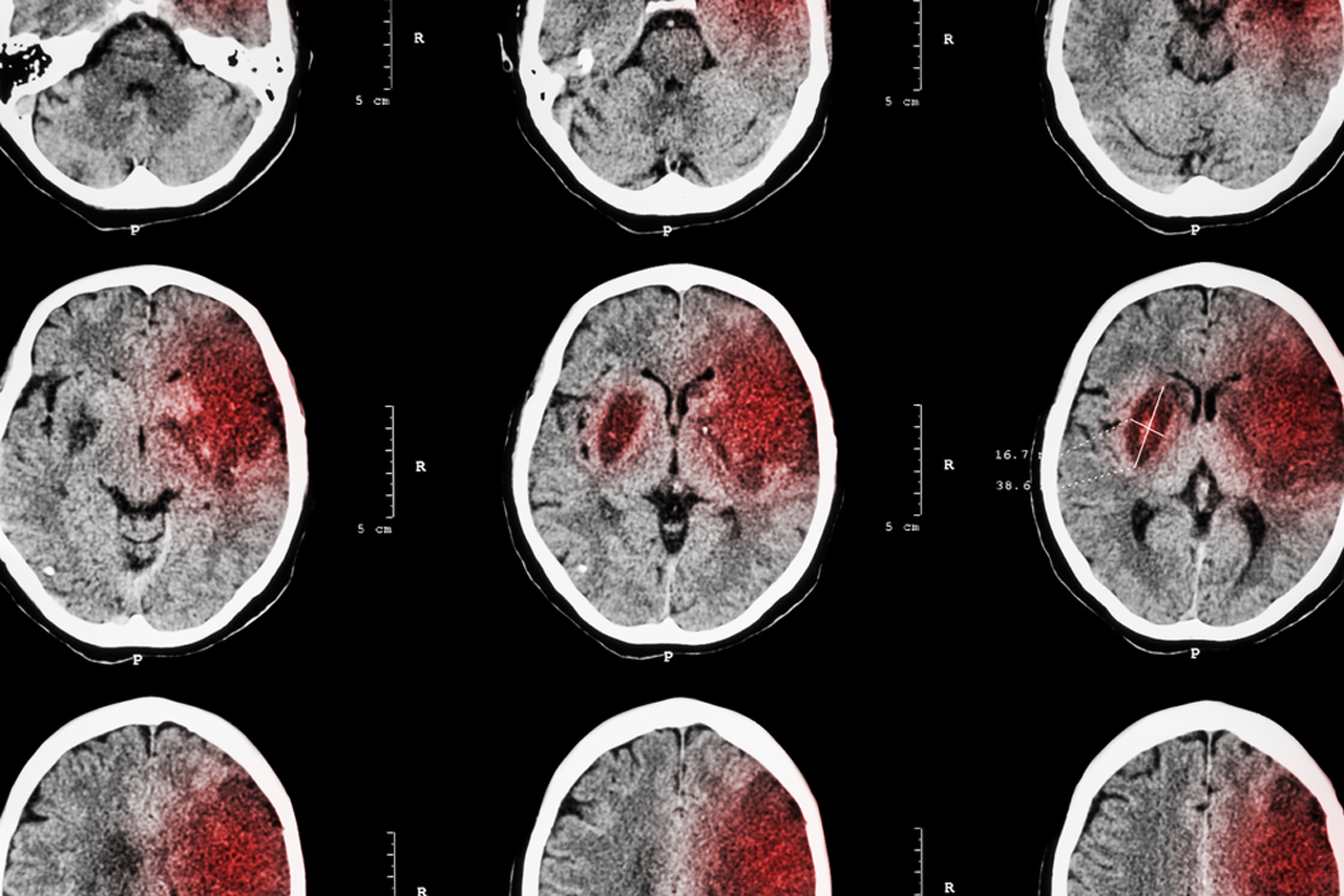 Πως συνδέονται οι εγκεφαλικές κακώσεις με τον κίνδυνο εμφάνισης άνοιας