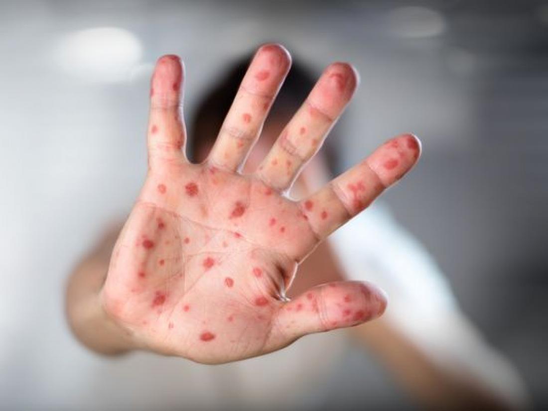 Τέταρτος θάνατος από ιλαρά – Τι συστήνουν οι ειδικοί