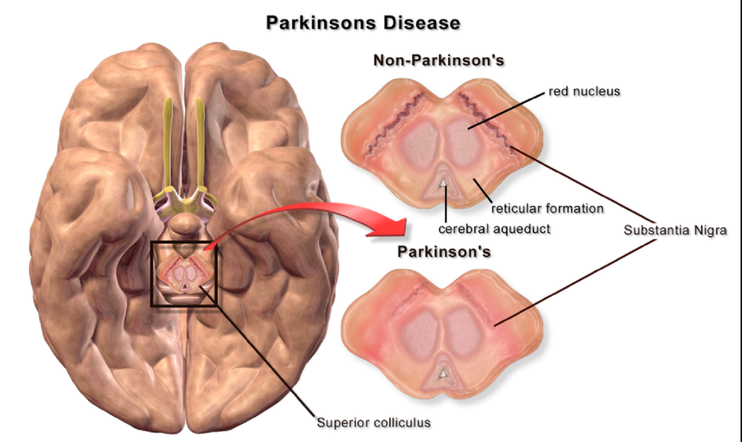 Με ποια άλλη πάθηση συνδέεται η νόσος Πάρκινσον