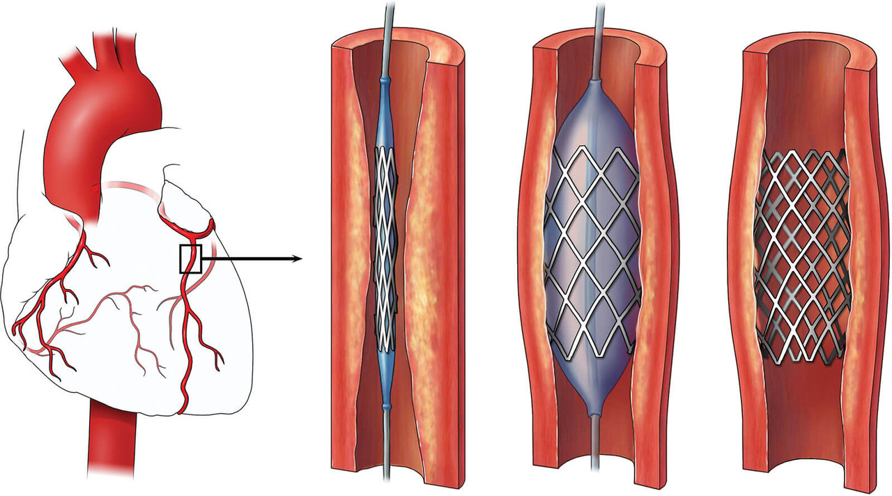 Το “έξυπνο stent” ανιχνεύει τη στένωση των αρτηριών