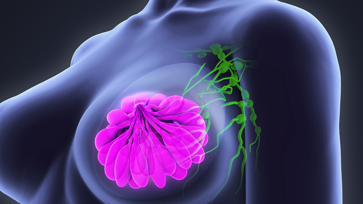 Νέα γονίδια σχετίζονται με τον κίνδυνο καρκίνου του μαστού