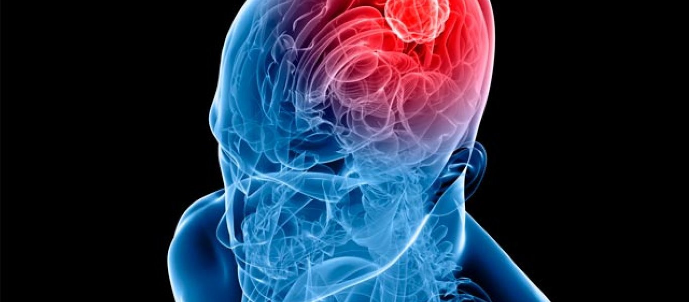 Ανακαλύφθηκε το “κλειδί ” εκκίνησης για τον όγκο στον εγκέφαλο