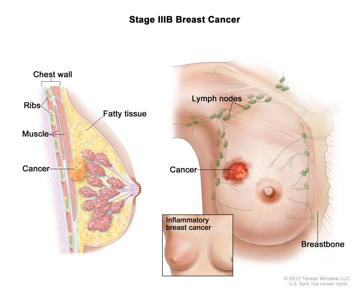 Καρκίνος του μαστού – Προειδοποιητικά σημάδια