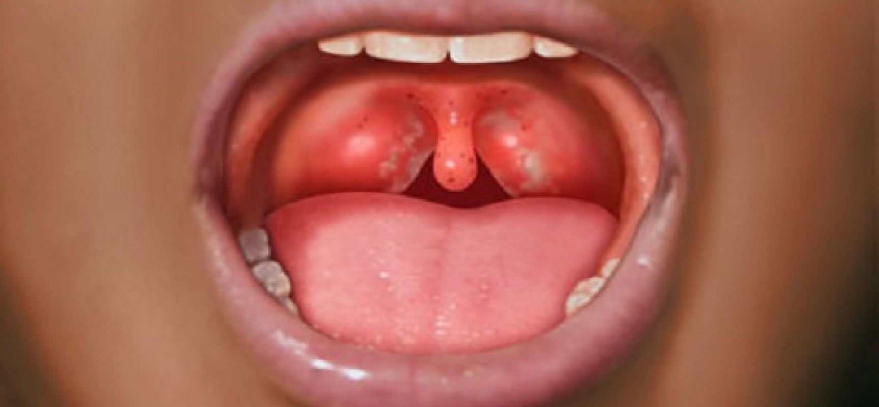 Πρώιμα συμπτώματα καρκίνου του στόματος