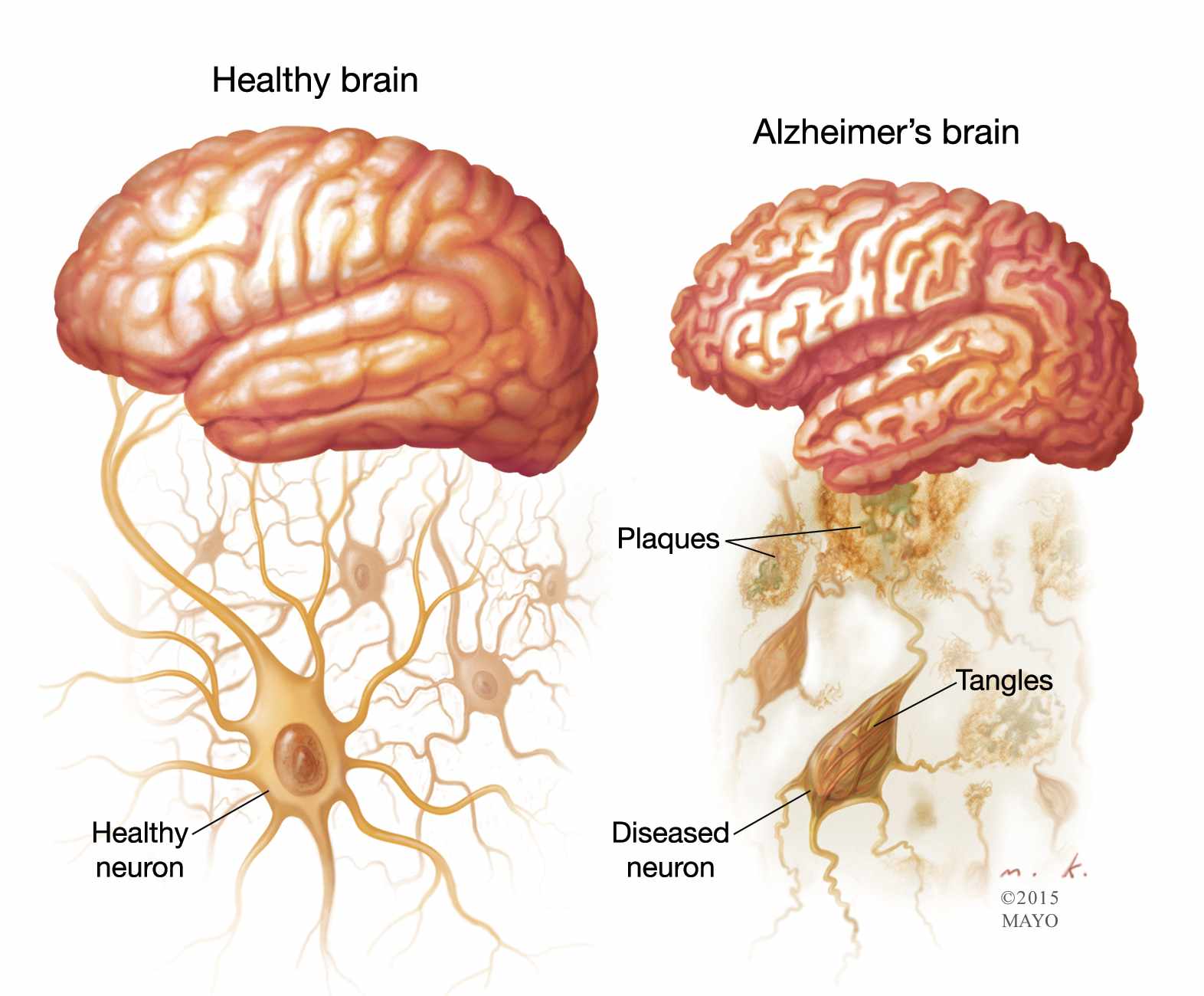 Μια νέα προσέγγιση για την εύρεση θεραπειών του Alzheimer