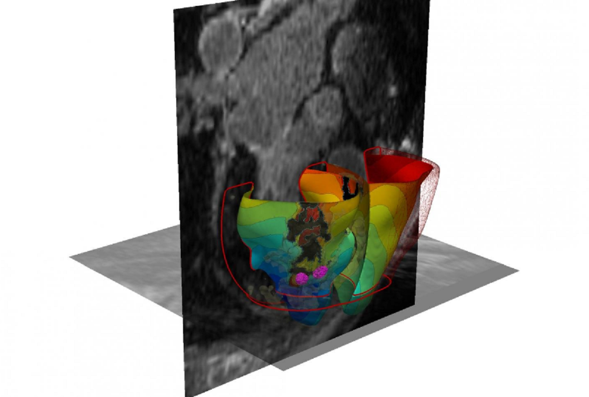 Η 3-D εικονική προσομοίωση των ακανόνιστων καρδιακών παλμών
