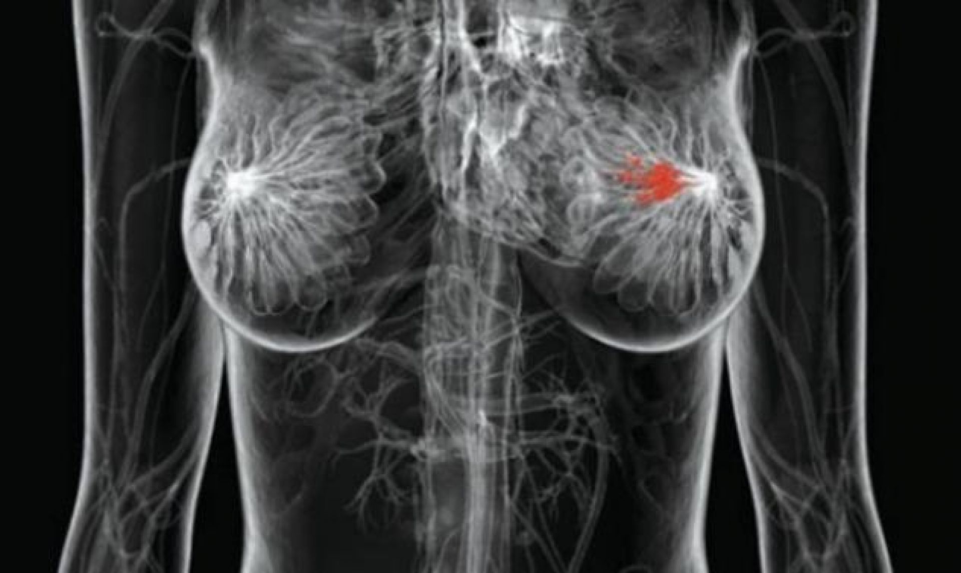 Νέα τεχνολογία ασπίδα για τον καρκίνο του μαστού