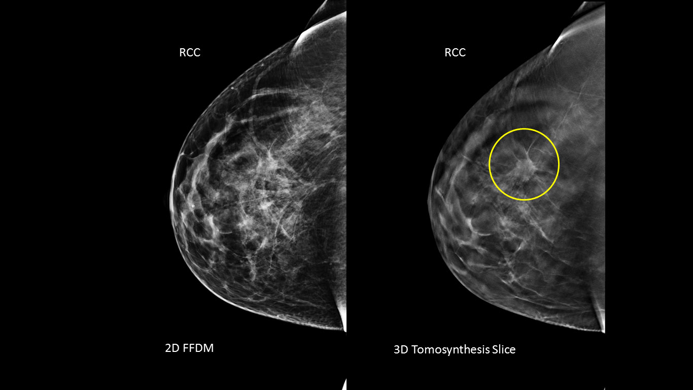 Η 3D μαστογραφία ανίχνευσε 34% παραπάνω καρκίνους μαστού