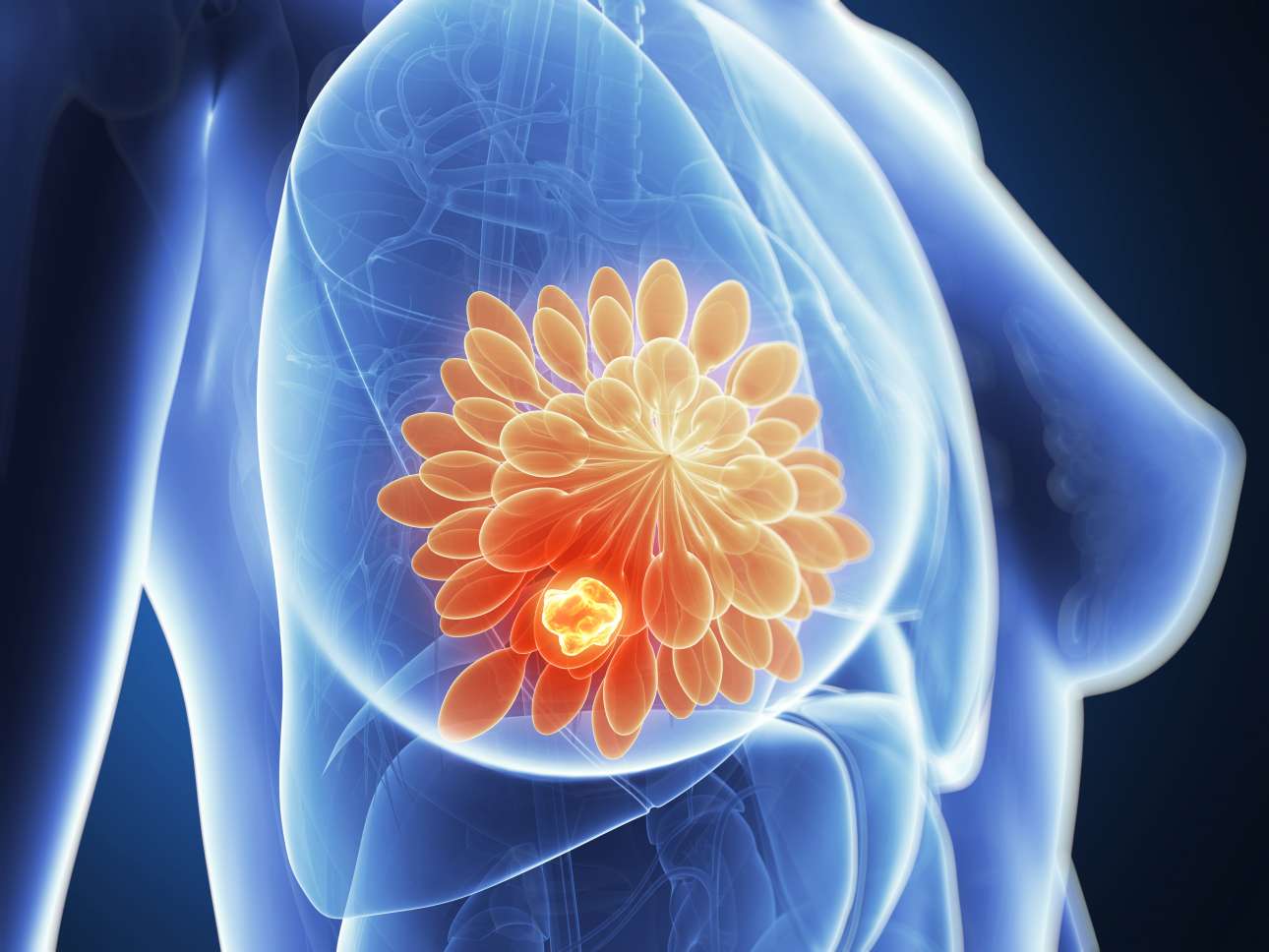 Τα θετικά της ανοσοθεραπείας για τον τριπλά αρνητικό καρκίνο του μαστού