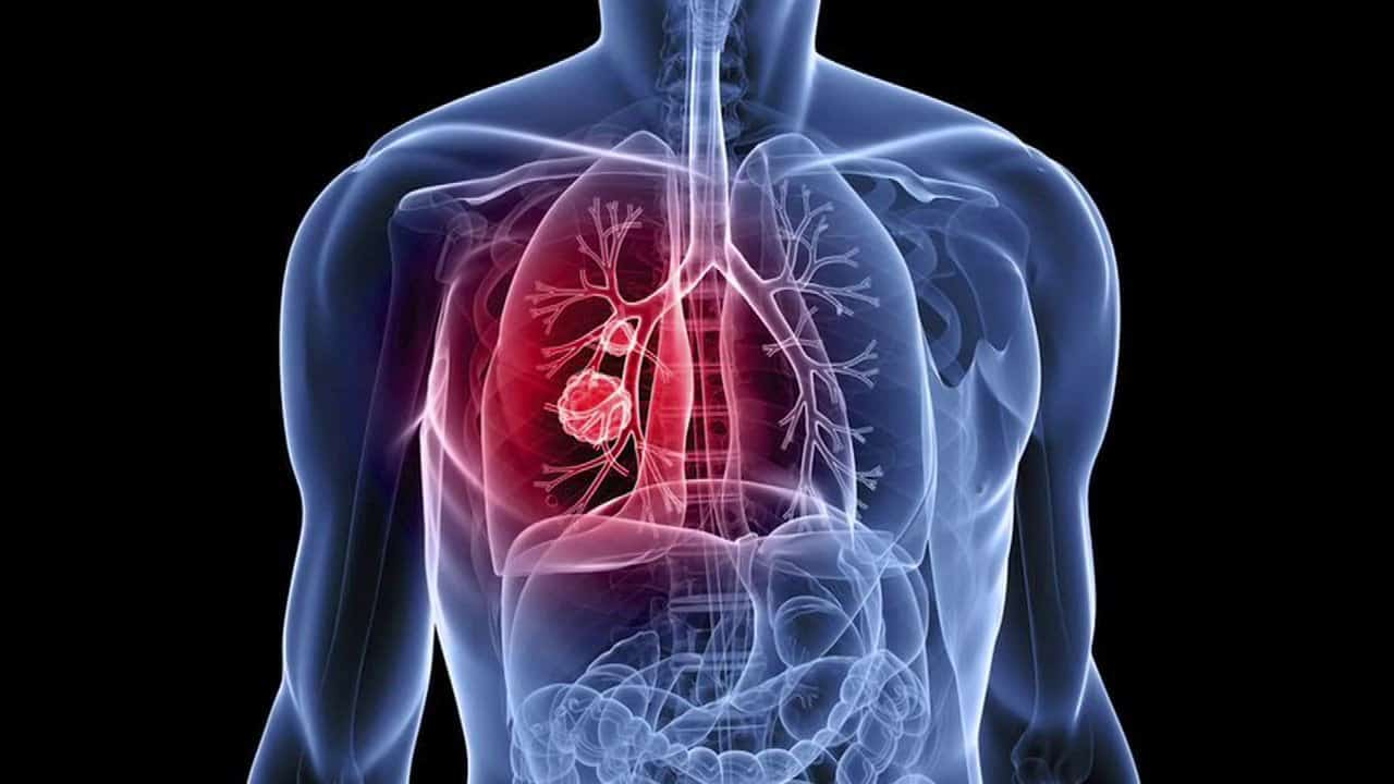 Ένοχα σημάδια δείχνουν καρκίνο του πνεύμονα