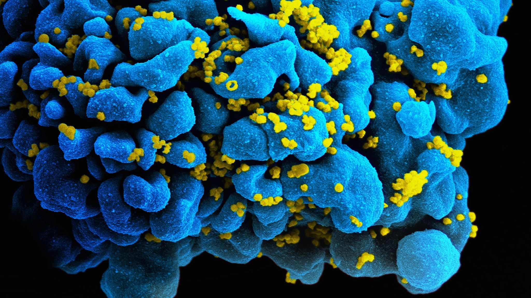 Επιστήμονες επιχείρησαν να καθαρίσουν μολυσμένα με HIV κύτταρα