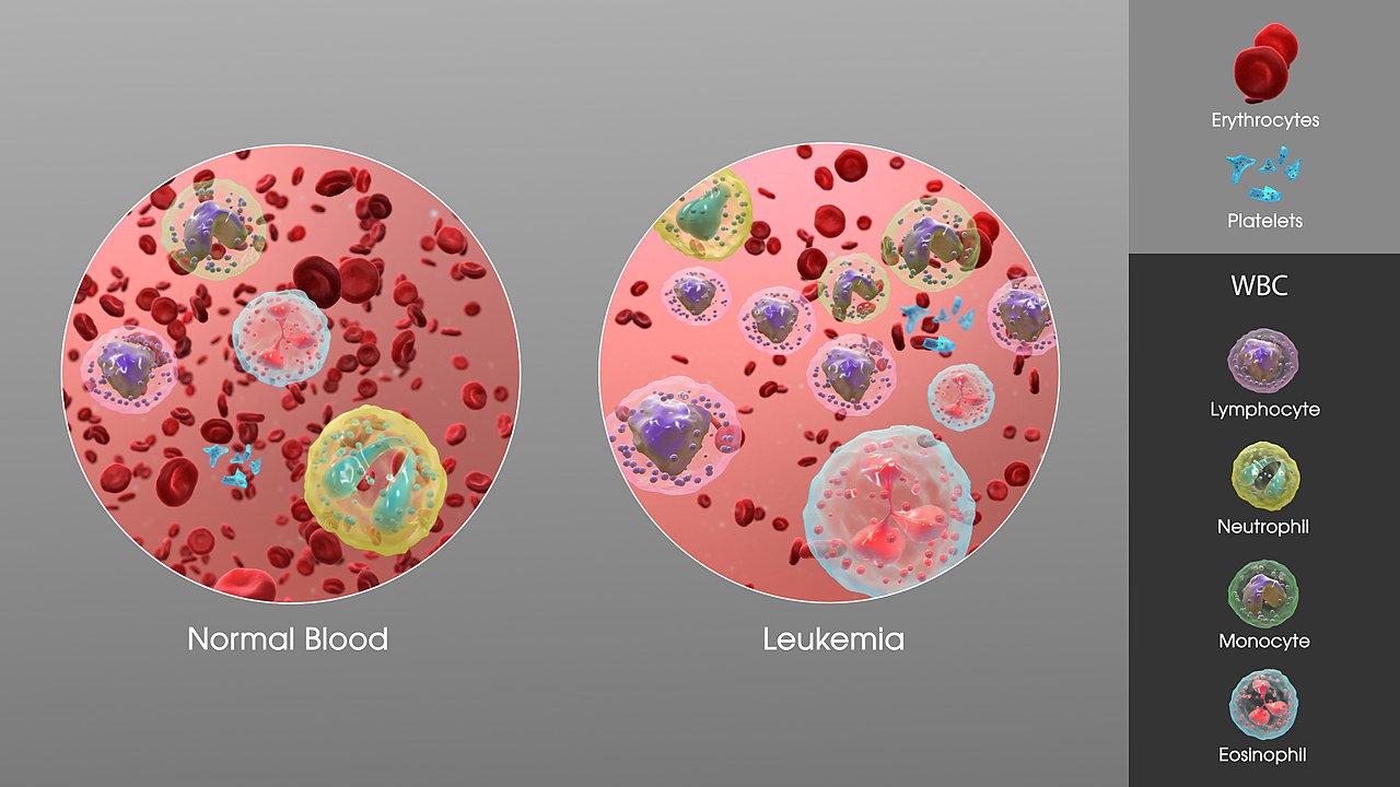 Αποκαλυπτική μελέτη για τη λεμφοκυτταρική λευχαιμία