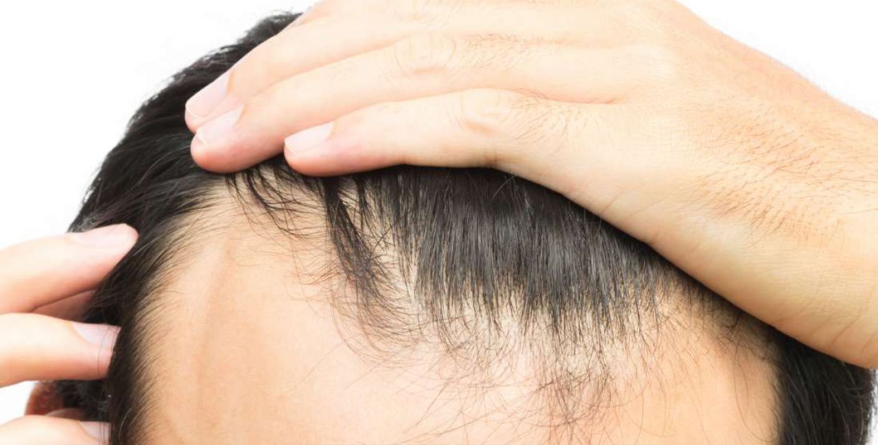Πότε η αραίωση στα μαλλιά κρύβει σοβαρό κίνδυνο υγείας