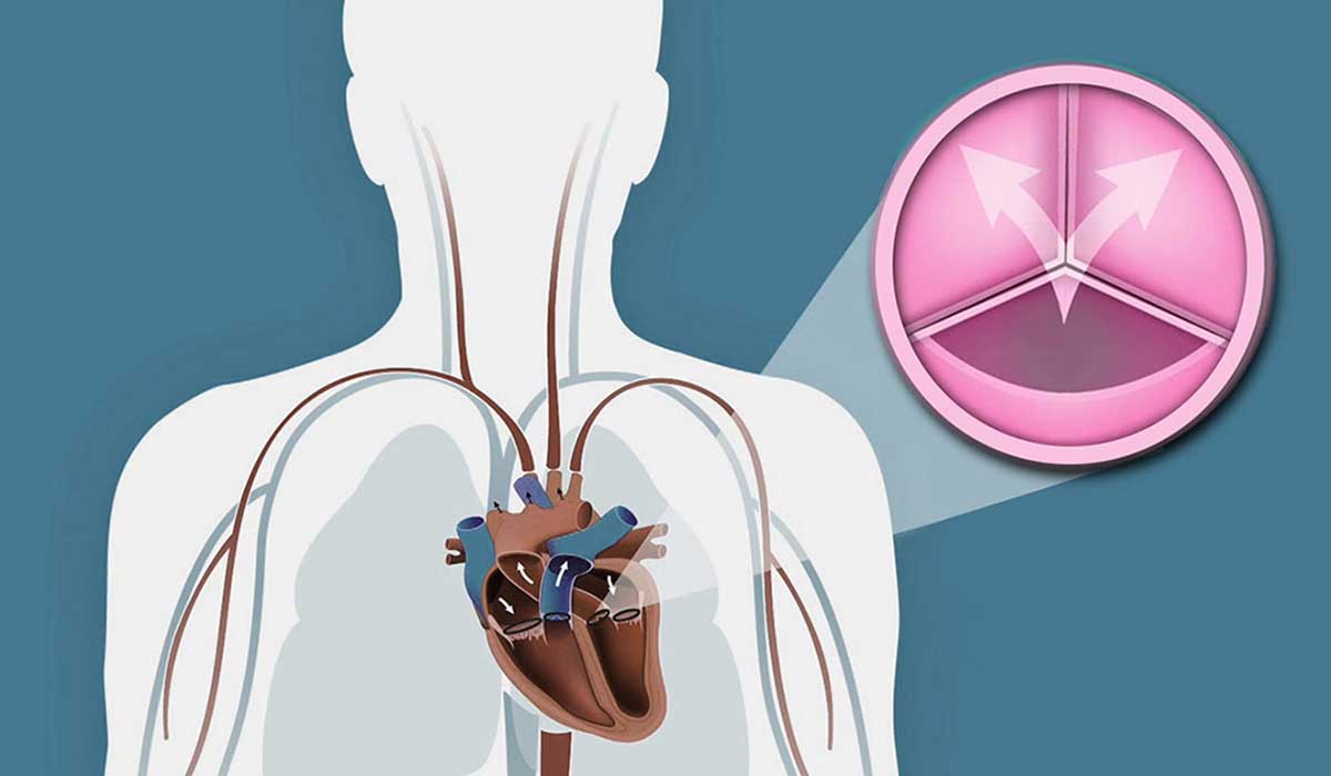 Πότε αυξάνει ο κίνδυνος στένωσης αορτικής βαλβίδας