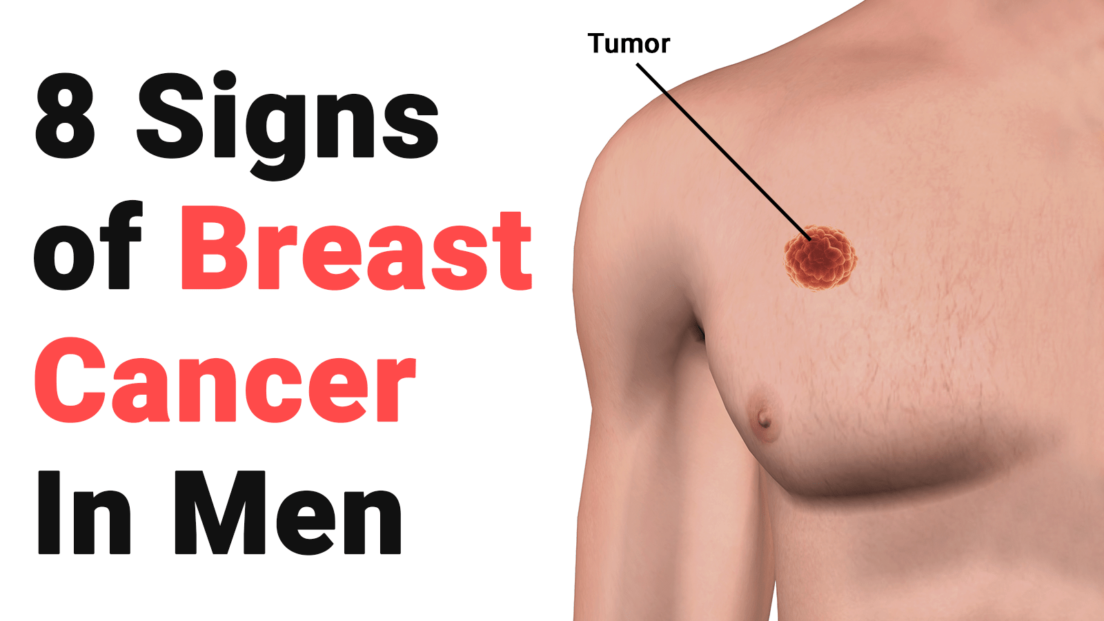 Όταν ο καρκίνος του μαστού χτυπάει τους άνδρες