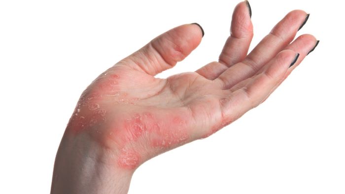 psoriasi9
