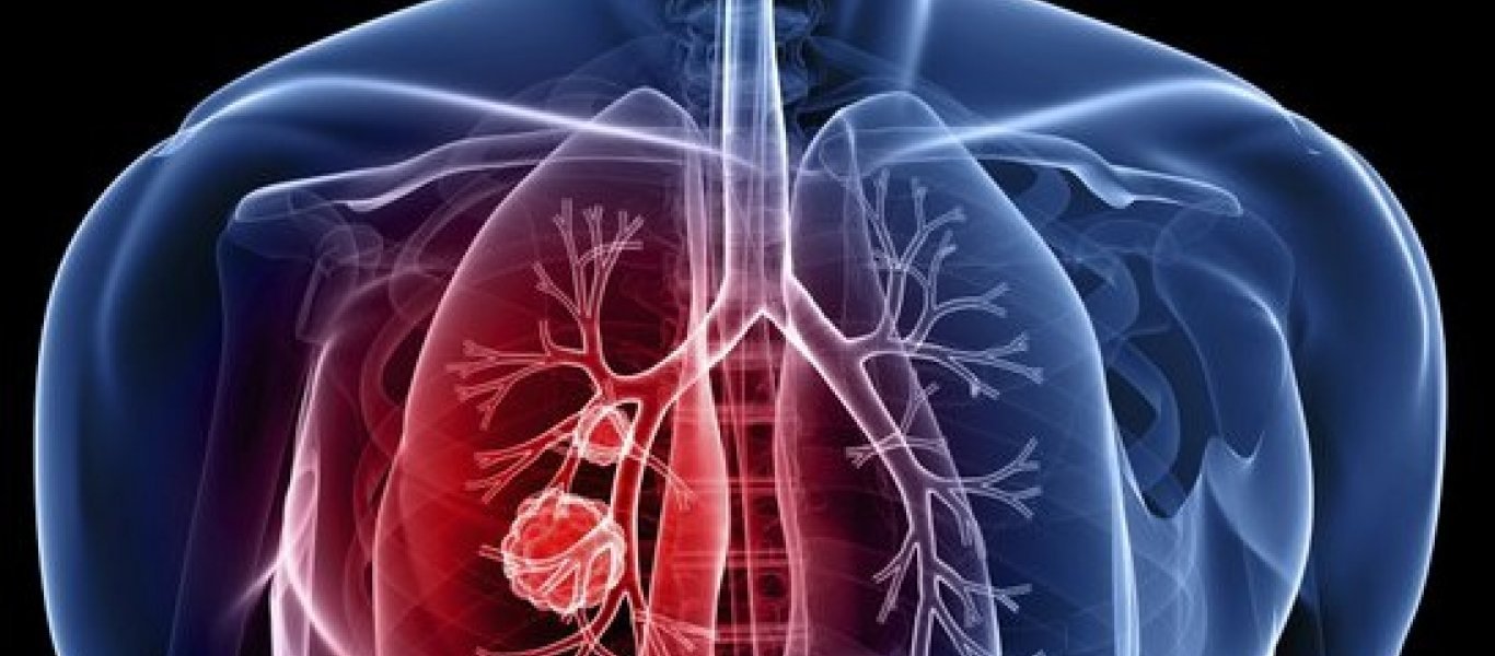 Ανακαλύφθηκε μεταστατικός παράγοντας του καρκίνου του πνεύμονα