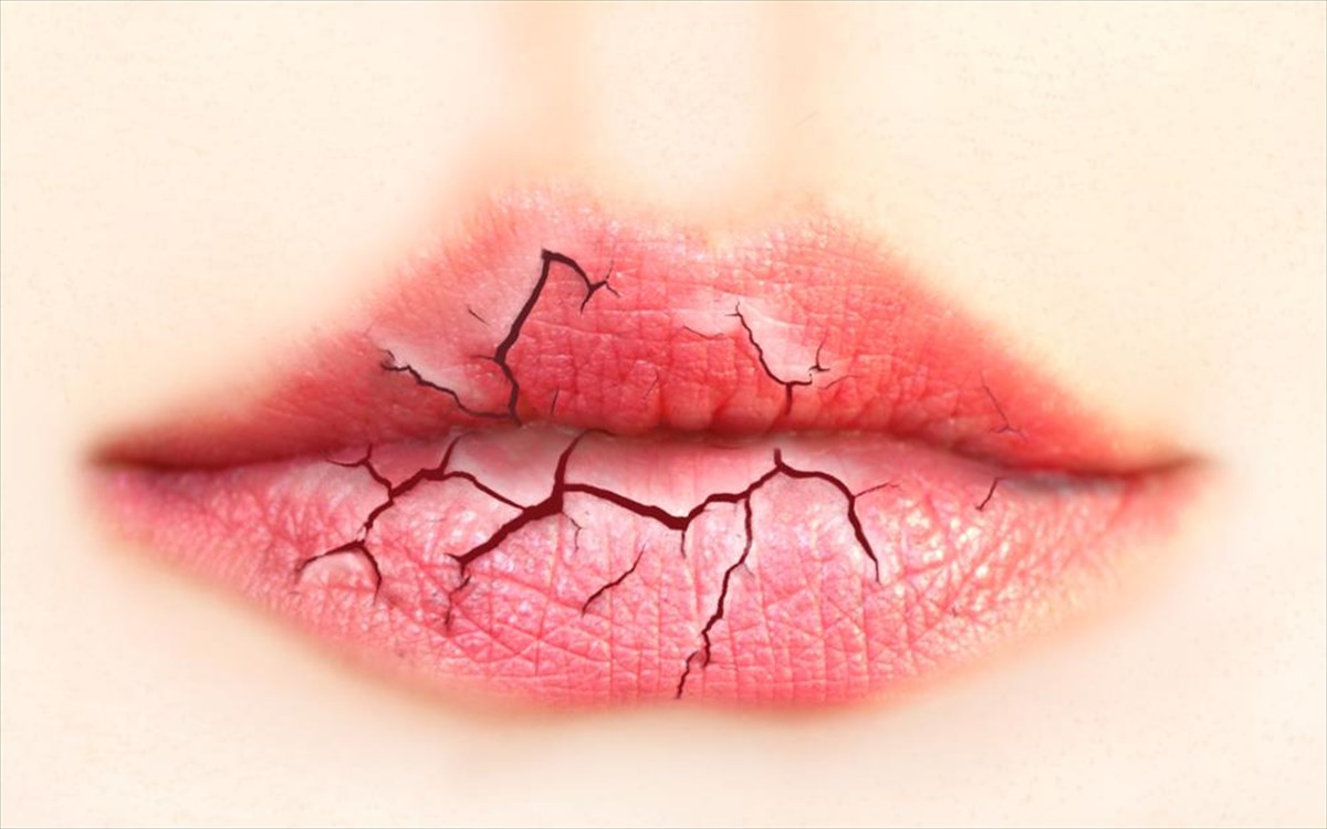 Πέντε tips για να απαλλαγείτε από τα σκασμένα χείλη