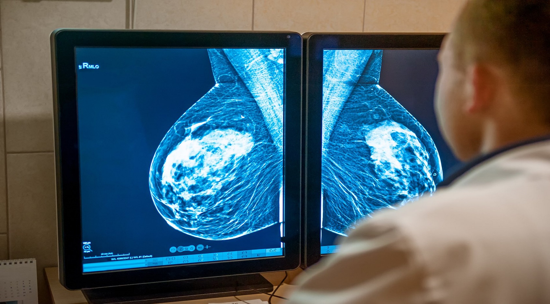 Σύστημα τεχνητής νοημοσύνης εντοπίζει τον καρκίνο του μαστού