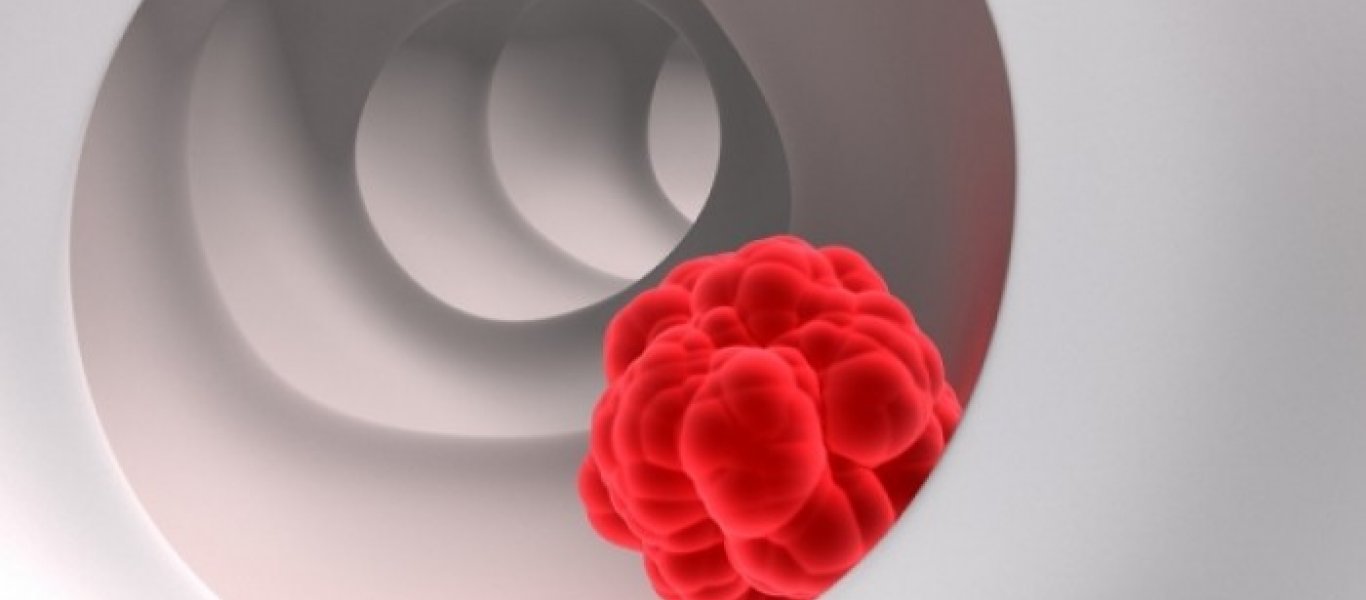 Πότε η ελκώδης κολίτιδα μπορεί να εξελιχθεί σε καρκίνο του παχέος εντέρου