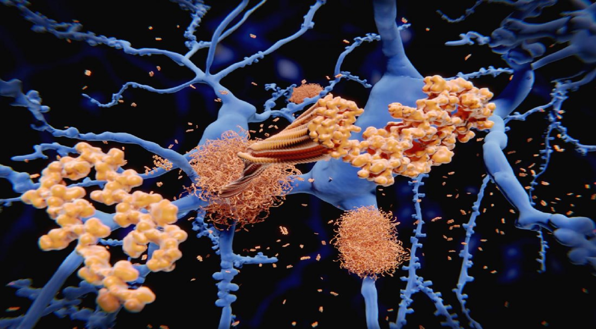 Η ανάπτυξη πρωτεϊνών του εγκεφάλου επηρεάζει τα γονίδια στη νόσο του Alzheimer