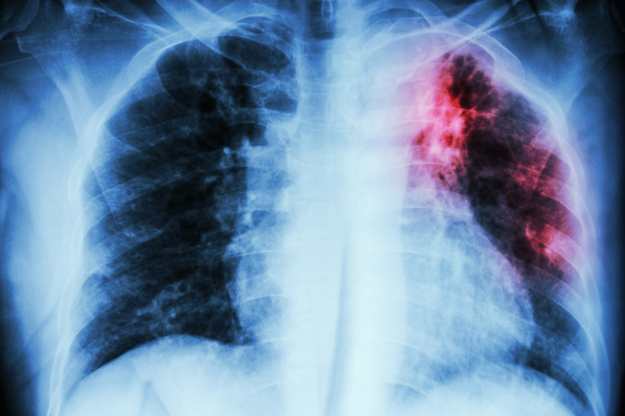 Συστάσεις σε ασθενείς με πνευμονικά νοσήματα & φυματίωση λόγω κοροναϊού