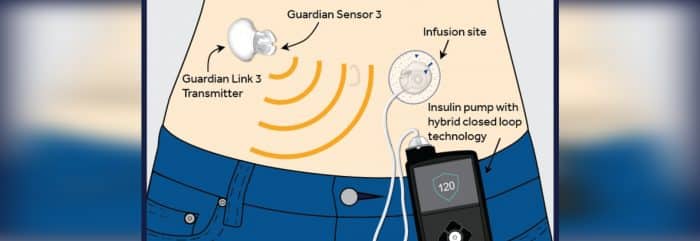 Medtronic: Απόκτηση σήμανσης για Υβριδικό Σύστημα Αντλίας Ινσουλίνης επόμενης γενιάς