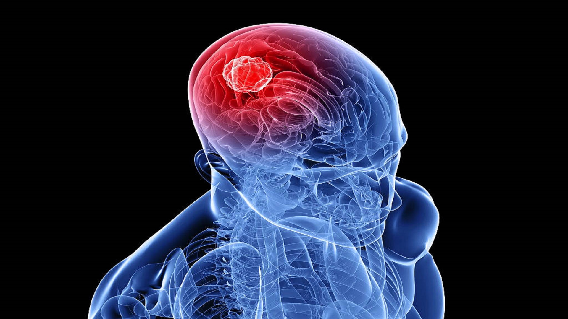 Νέα τεχνική ακτινοθεραπείας στοχεύει τα καρκινικά κύτταρα του εγκεφάλου