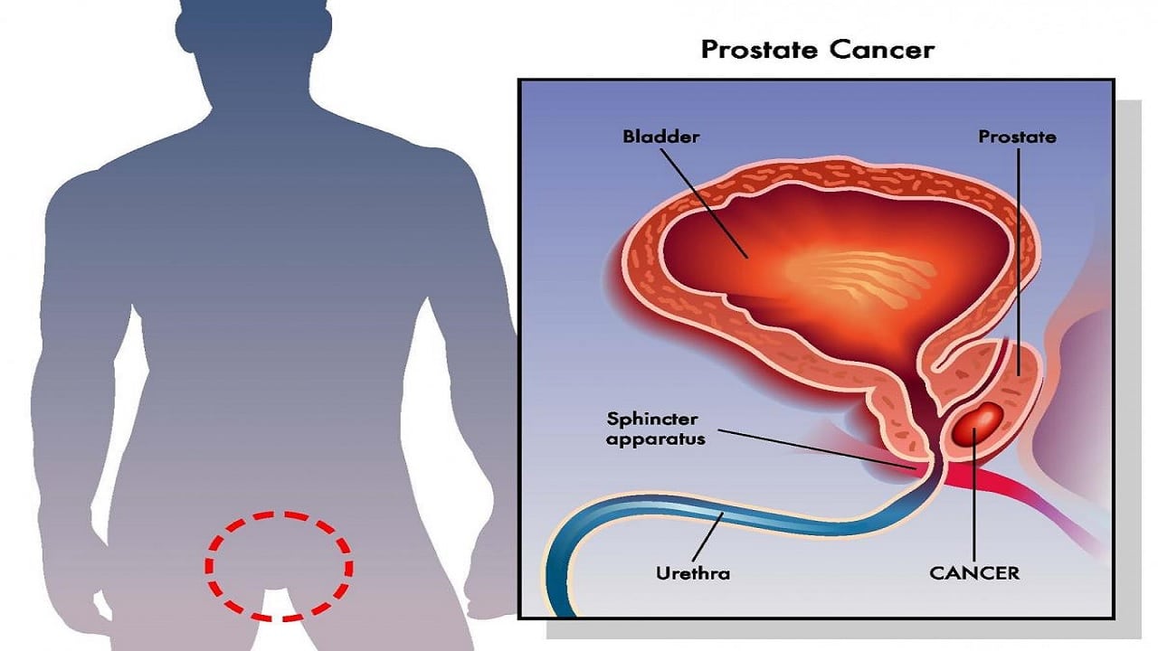 Καρκίνος προστάτη προσδόκιμο ζωής: Πότε αυξάνεται σημαντικά ο κίνδυνος θανάτου