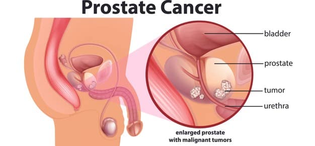 cancer prostate.jpg