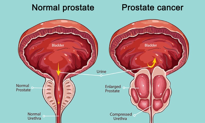 surgery-prostate-cancer.jpg