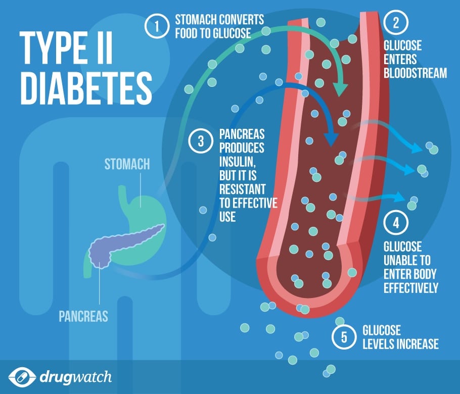 type-2-diabetes.jpg